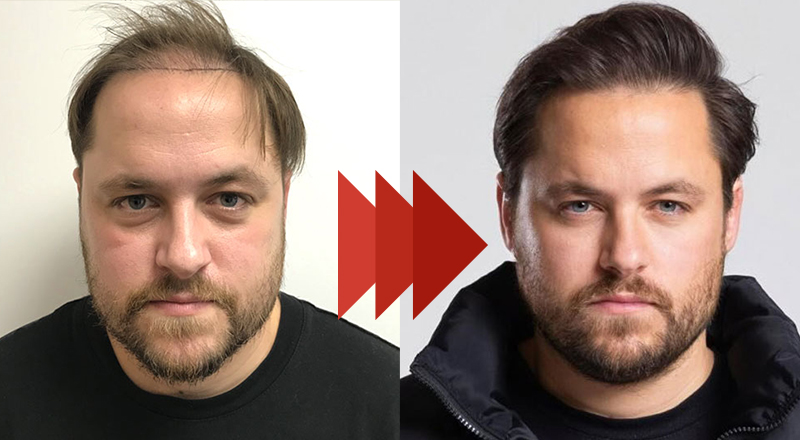 Results after 6 months
